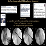 Do you have hip pain? Avascular Necrosis of the Hip?  Regenerative Medicine for Hip Pain.