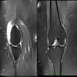 Meniscus Tear? Surgery is not always necessary